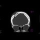 Depressive fracture of skull: CT - Computed tomography